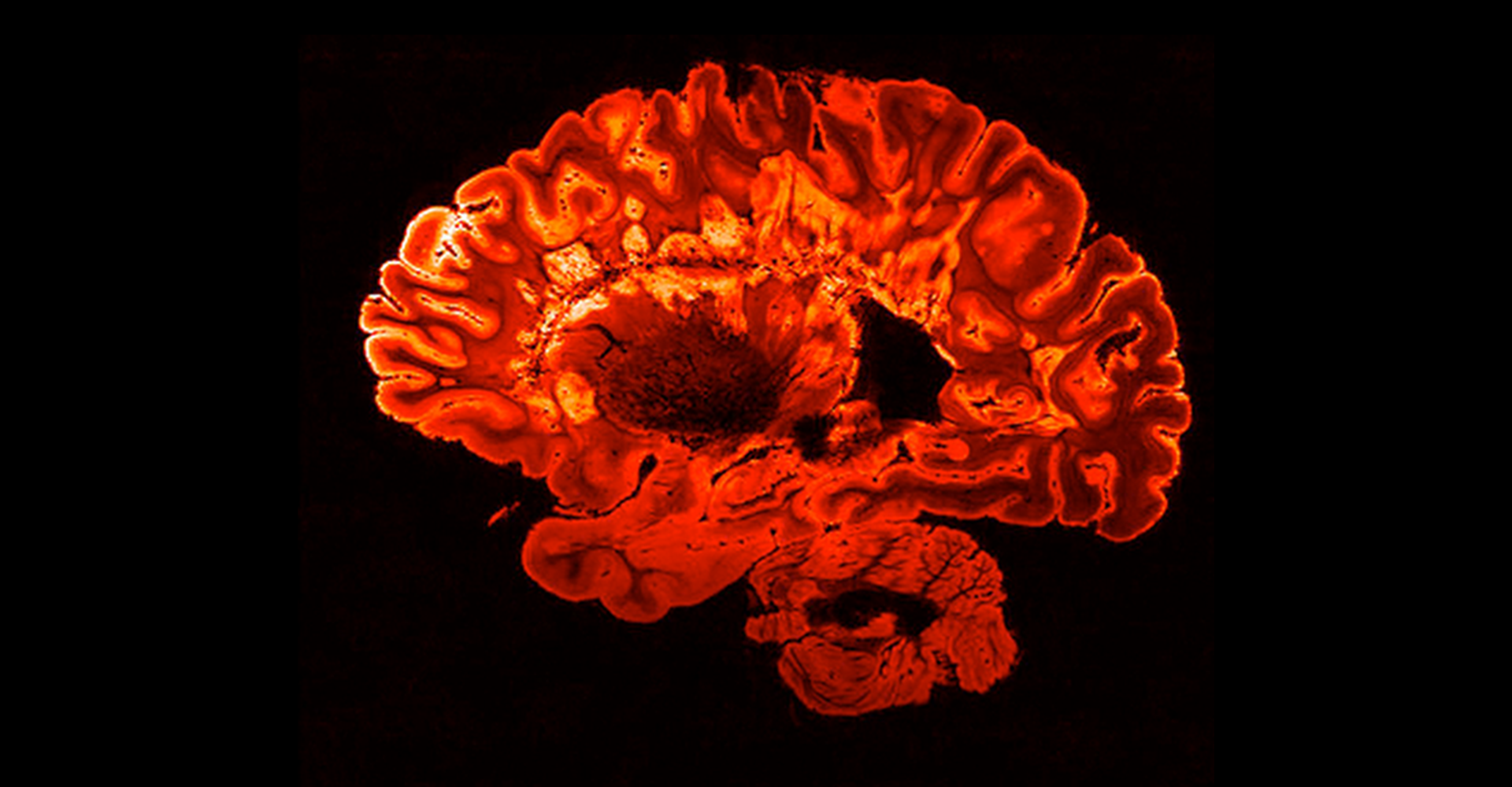 أحمر التصوير بالرنين المغناطيسي فحص الدماغ